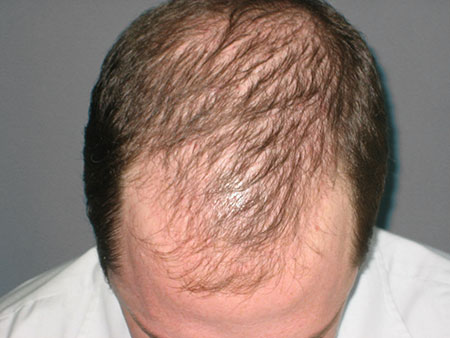 Alopecia androgénica | Minoxidil Costa Rica