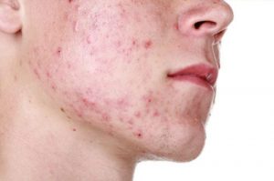 acne y minoxidil