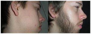 Dónde comprar minoxidil