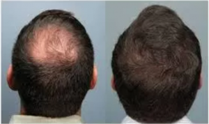 alopecia genetica